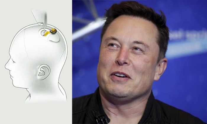 Η Neuralink του Elon Musk έκανε την πρώτη εμφύτευση μικροτσίπ σε ανθρώπινο εγκέφαλο